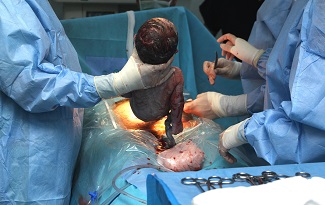 Cesarean childbirth