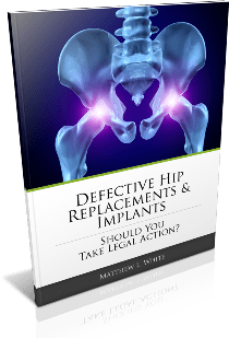 Free Guide to Defective Hip Replacement Lawsuits