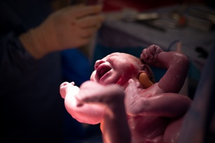 delayed c-section birth injury lawsuit