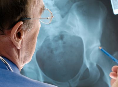 Defective DePuy hip implant lawsuits in Kentucky