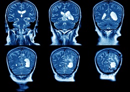 A traumatic brain injury can result from almost type of accident