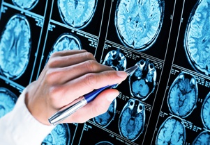 doctor examining brain scans showing epilepsy Gray & White