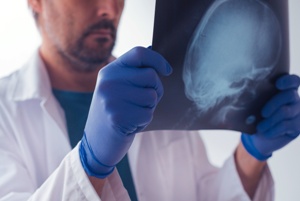 doctor looking at xray of a skull fracture
