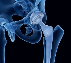 Stryker hip implants have a history of high failure rates