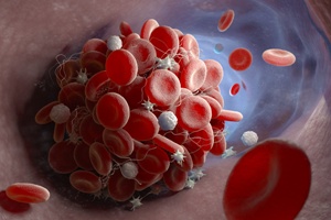 image of a blood clot in the bloodstream