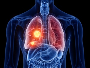 medical image of person with lung cancer