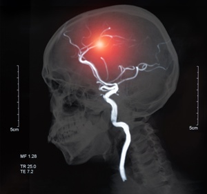 xray of brain aneurysm