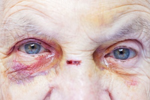 facial injuries nursing home abuse neglect