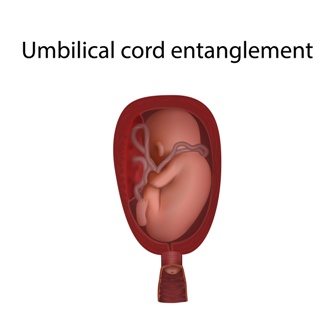 umbilical cord problems cause cerebral palsy