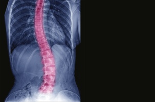 xray of spine with scoliosis