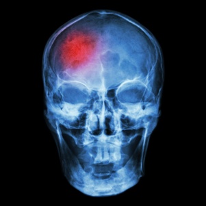 kentucky brain injury lawyers discuss brain contusions